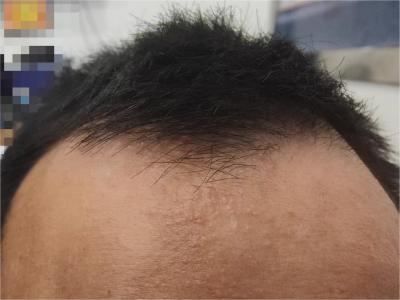 雄激素性脫髮患者前額髮際後退圖