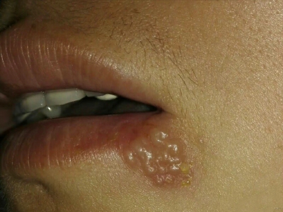 愛滋病感染性皮膚損害口周水皰圖