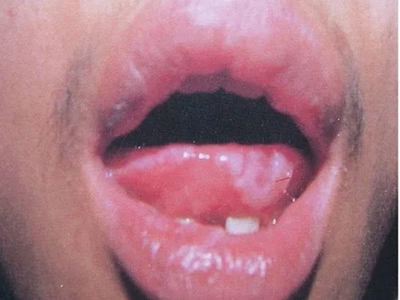 二期口腔梅毒舌尖有突出的白斑圖