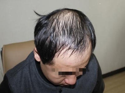 男性型脫髮頭頂頭髮稀少露頭皮圖