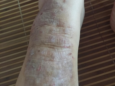 局限性神經性皮炎小腿皮膚粗糙圖 局限性神經性皮炎小腿皮膚粗糙圖