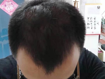 男性型脫髮額頭兩邊髮際線高圖 男性型脫髮額頭兩邊髮際線高圖