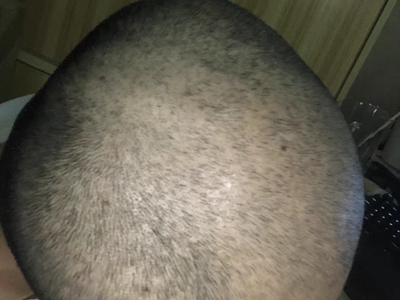 雄激素性脫髮頭頂的頭髮輕微脫落圖