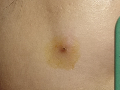 皮脂腺囊腫背部出現小潰瘍圖 皮脂腺囊腫背部出現小潰瘍圖