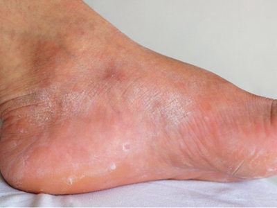 水源性肢端角化病腳上出現白斑圖 水源性肢端角化病腳上出現白斑圖