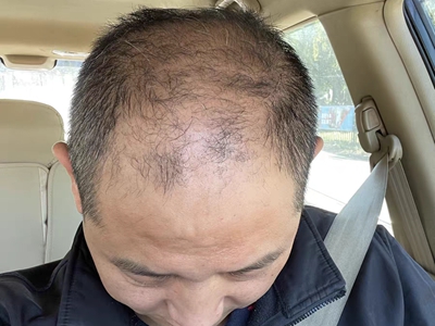 雄激素性脫髮頭頂脫髮露大片頭皮圖 雄激素性脫髮頭頂脫髮露大片頭皮圖