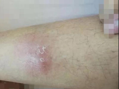 硬結性紅斑小腿上有紅色疙瘩圖