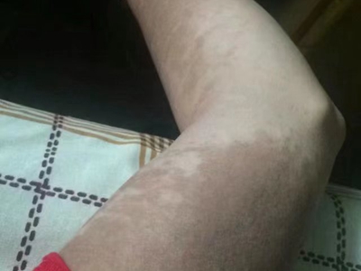 咖啡斑上肢有大面積黃褐色斑塊圖