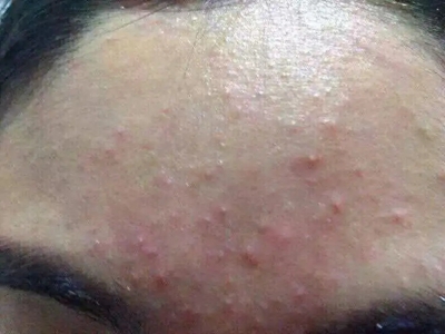 化妝品性痤瘡前額上小的紅色丘疹圖