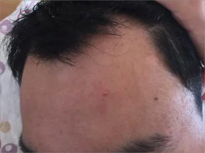 男性型脫髮額頭兩側髮際線高圖 男性型脫髮額頭兩側髮際線高圖