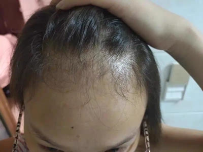 雄激素性脫髮髮際線變高頭髮稀疏圖 雄激素性脫髮髮際線變高頭髮稀疏圖
