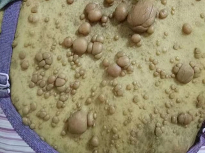 皮膚纖維瘤背部有大大小小的疙瘩圖 皮膚纖維瘤背部有大大小小的疙瘩圖