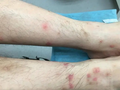 蠓蟲叮咬腿上有紅色片狀疙瘩圖 蠓蟲叮咬腿上有紅色片狀疙瘩圖