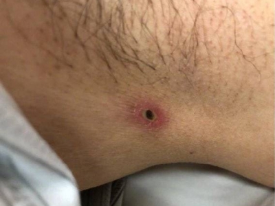 恙蟲病腋窩有凸起的外紅內黑焦痂圖