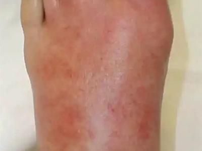 嗜酸性蜂窩織炎整隻腳背紅腫圖