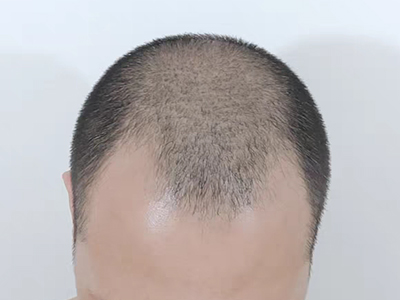 雄激素性脫髮前額兩側的頭髮脫落圖 雄激素性脫髮前額兩側的頭髮脫落圖