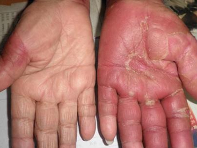 煙酸缺乏症手掌紅斑腫脹圖 煙酸缺乏症手掌紅斑腫脹圖