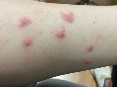 硬結性紅斑小腿上紅色小結節圖