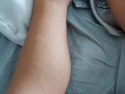 線狀苔蘚腿上有很多小疹子圖 線狀苔蘚腿上有很多小疹子圖