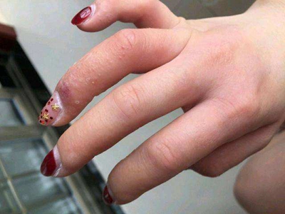 手部濕疹手指起小疙瘩伴脫屑圖 手部濕疹手指起小疙瘩伴脫屑圖