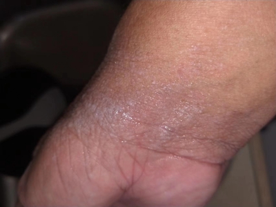 水源性肢端角化病手腕有灰白色斑圖