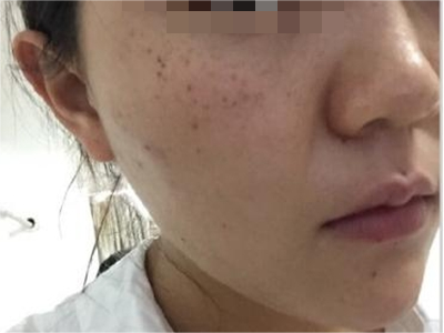 雀斑顴部長了很多深褐色的斑圖