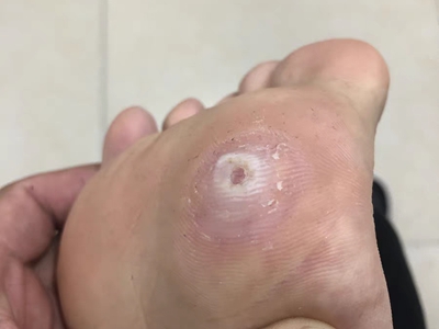 胼胝腳底有個發白的硬塊中間有坑圖 胼胝腳底有個發白的硬塊中間有坑圖