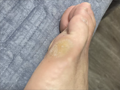 胼胝小腳趾下面有個黃色大硬塊圖