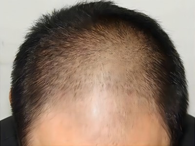 男性型脫髮前額有兩塊脫髮區圖