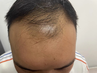 雄激素性脫髮頭髮脫落額頭寬大圖 雄激素性脫髮頭髮脫落額頭寬大圖