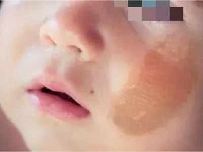 咖啡斑臉上大片淺咖色不規則斑圖