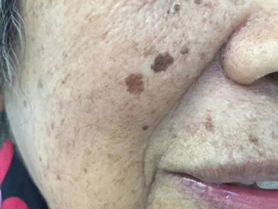 光線性角化病面部上有幾個斑圖 光線性角化病面部上有幾個斑圖