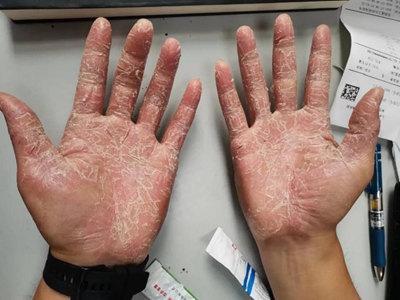 手部濕疹手掌大面積紅斑脫皮圖 手部濕疹手掌大面積紅斑脫皮圖