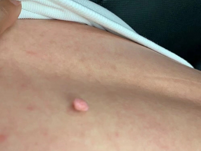 皮膚纖維瘤背部長個肉疙瘩圖 皮膚纖維瘤背部長個肉疙瘩圖