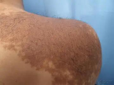 色素性毛表皮痣後背大塊褐斑圖 色素性毛表皮痣後背大塊褐斑圖