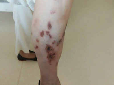 人工性脂膜炎小腿爛了幾片結痂圖 人工性脂膜炎小腿爛了幾片結痂圖