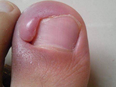 嵌甲大腳趾甲邊上出現粉色肉疙瘩圖 嵌甲大腳趾甲邊上出現粉色肉疙瘩圖
