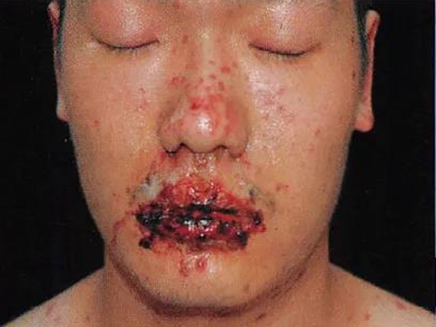 重型多形紅斑嘴唇長血皰糜爛結痂圖
