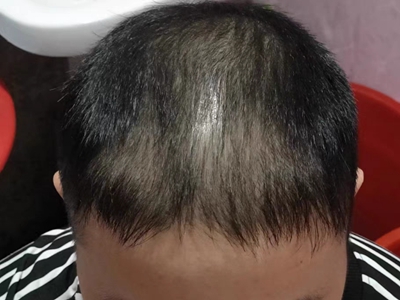 雄激素性脫髮頭頂出現大面積脫髮圖 雄激素性脫髮頭頂出現大面積脫髮圖