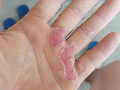胼胝手掌脫皮露出發紅的皮膚圖