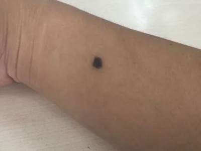 良性幼年黑素瘤手臂上黑痣圖 良性幼年黑素瘤手臂上黑痣圖