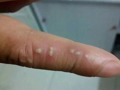 皰疹樣膿皰病手指上白色膿皰圖