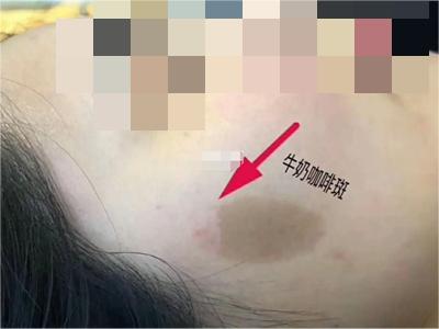 咖啡斑臉上有一片橢圓形咖啡色斑圖