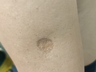 萎縮性瘢痕胳膊上有一個圓坑圖