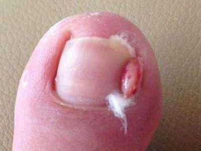 嵌甲大腳趾甲邊上出現小肉疙瘩圖 嵌甲大腳趾甲邊上出現小肉疙瘩圖