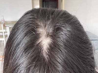 女性型脫髮頭皮中央禿了一塊圖