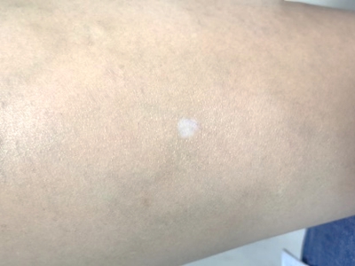 特發性滴狀色素減少症小腿白斑圖 特發性滴狀色素減少症小腿白斑圖