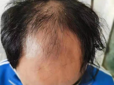 雄激素性脫髮頭髮大面積脫落圖