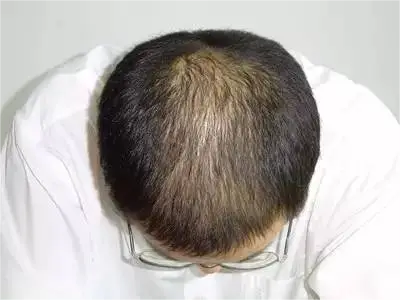 男性型脫髮頭頂中間頭髮稀少圖 男性型脫髮頭頂中間頭髮稀少圖