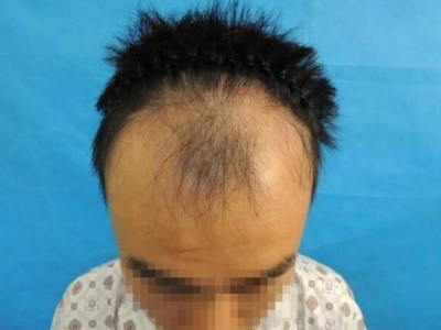 男性型脫髮額頭嚴重脫髮頭髮稀疏圖 男性型脫髮額頭嚴重脫髮頭髮稀疏圖